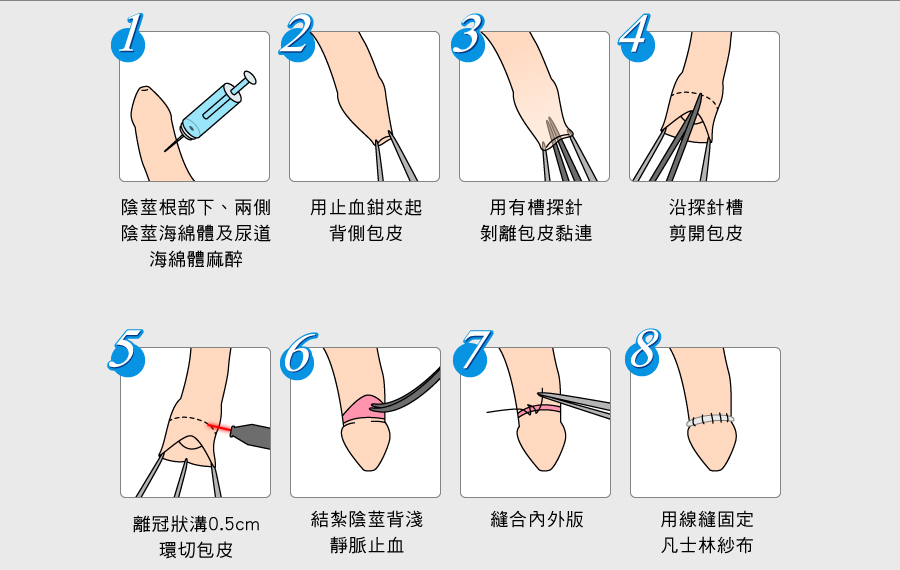 包莖 包莖嚴重程度自我檢測！包皮過長一定要割嗎？ 遇到這5種狀況別 ...